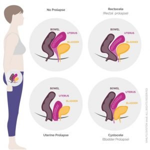 Read more about the article Breaking the Quiet: Tending to Pelvic Floor Disorders and Incontinence in Women