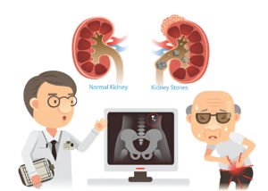 Read more about the article Kidney Stone Surgery: Advanced Treatment at Punitham Hospital, Madurai